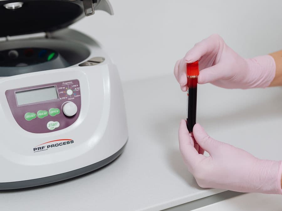 PRP platelet-rich plasma hair treatment