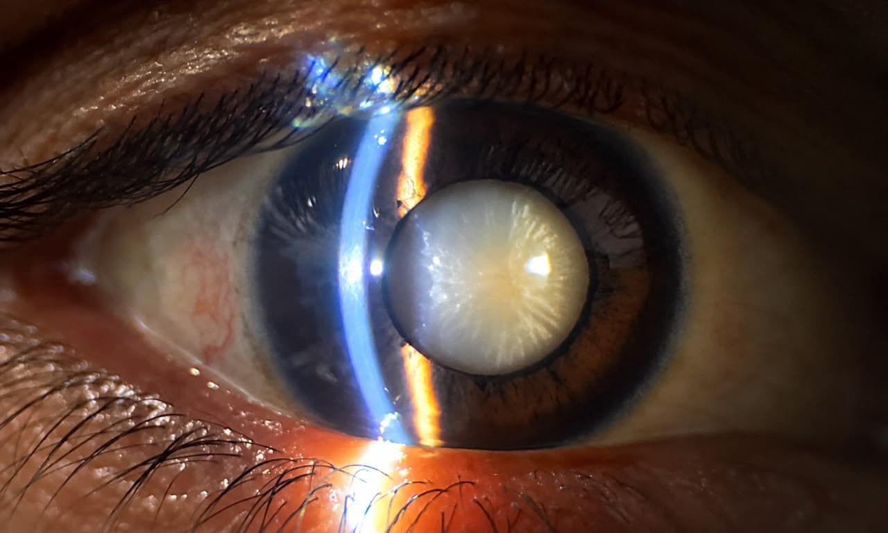Optometrist examining a young patient's eyes during cataract testing